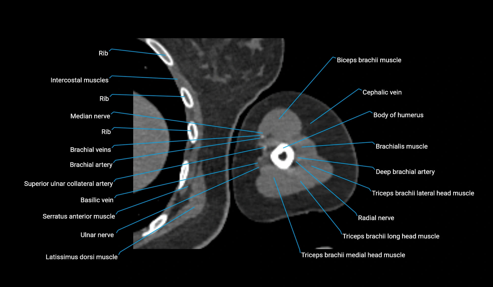 CT upper arm axial  cross sectional anatomy labelled radiology image -00258.webp
